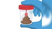 Imagen referencial de una muestra de heces. DEPOSITPHOTOS