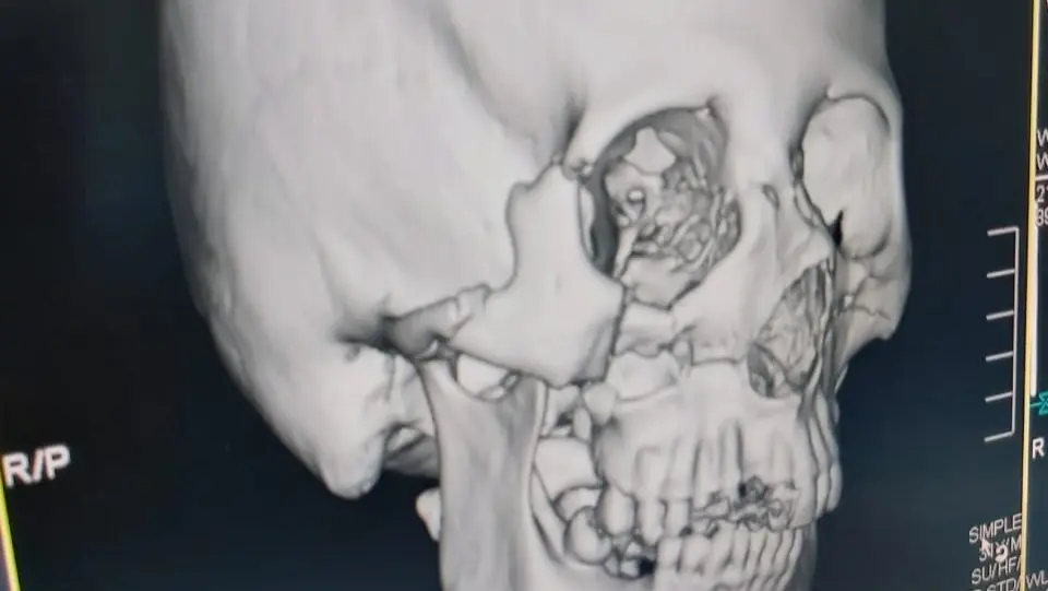 Una radiograf&iacute;a del rostro de la v&iacute;ctima que requiere ayuda para su reconstrucci&oacute;n. Foto: Voces Libres