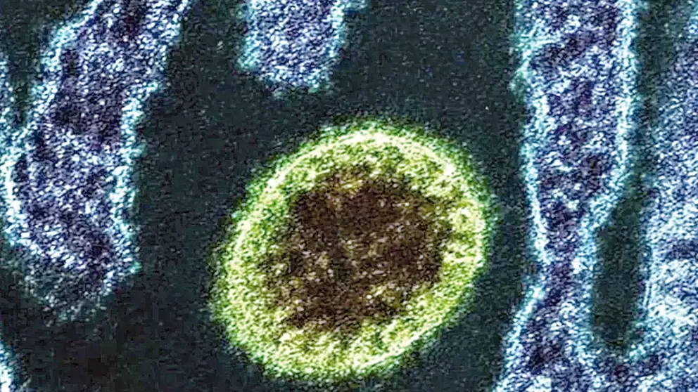 El nuevo henipavirus Langya (LayV).         INFOBAE