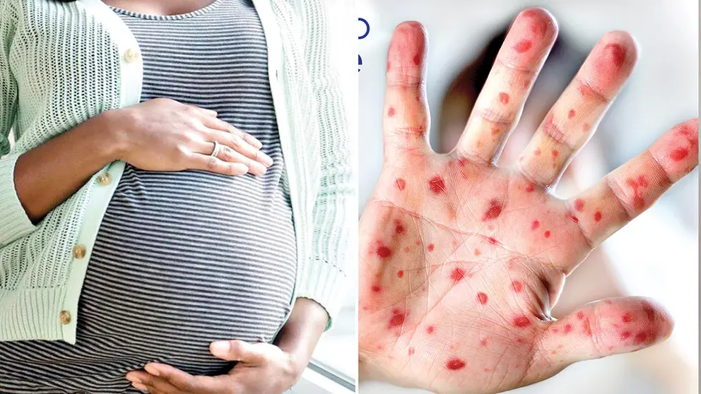 Im&aacute;genes referenciales de una mujer embarazada y la viruela del mono.  TUNOTA.COM