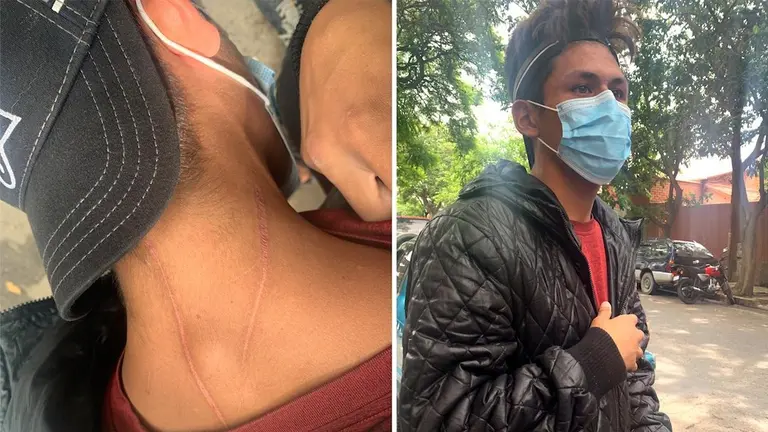 El joven Andr&eacute; Guill&eacute;n muestra las heridas causadas durante los enfrentamientos. BETTY CONDORI