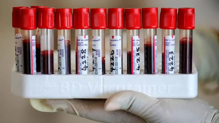 Una prueba de sangre podr&iacute;a predecir el desarrollo de alzh&eacute;imer. EFE