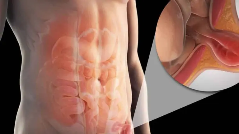 Una imagen referencial de la hernia inguinal. CEGA