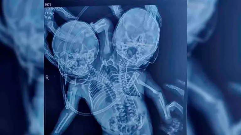 Captura de la radiograf&iacute;a del menor. Publicado T13