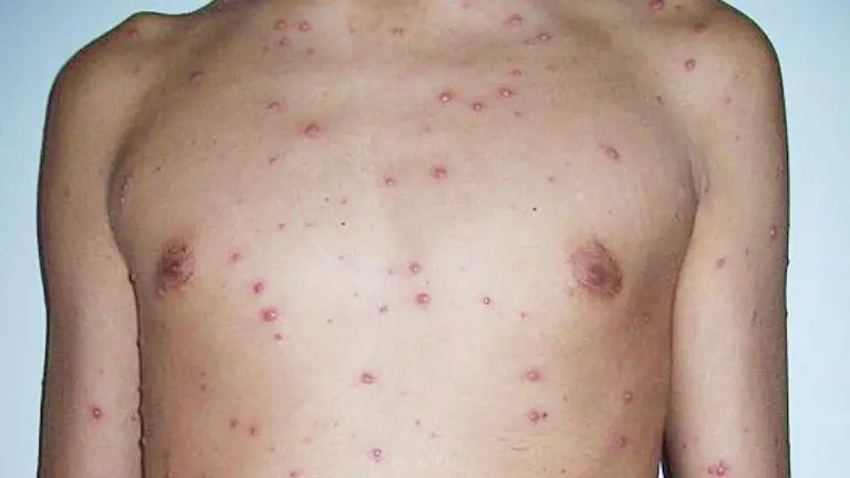 La infecci&oacute;n de la viruela del mono en una persona. ARCHIVO
