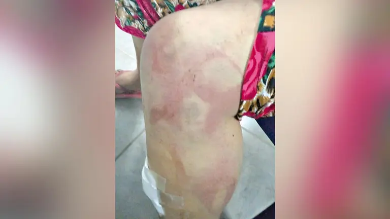 Fotografía de hematomas en el cuerpo de la víctima. MUJERES DE FUEGO