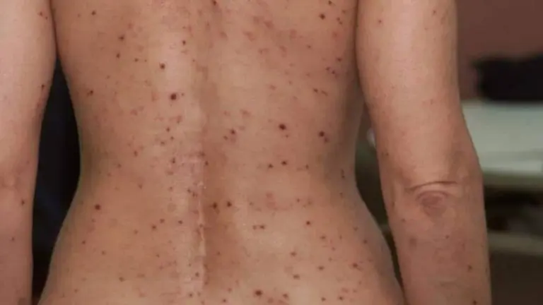 Imagen referencial del cuerpo de una persona de sexo femenino con erupciones. EL CIUDADANO
