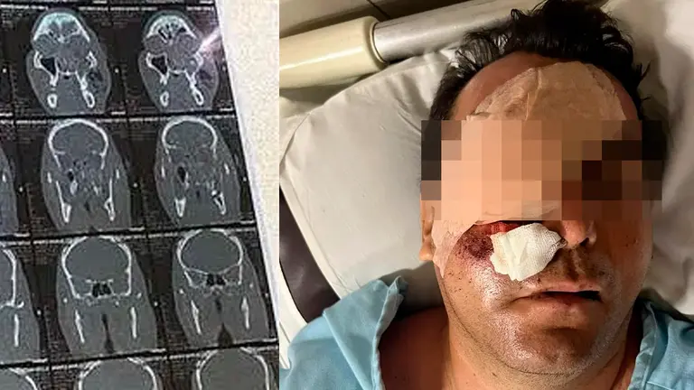 Una radiograf&iacute;a que expone el da&ntilde;o y una foto de Ch&aacute;vez. /El Deber y DTV