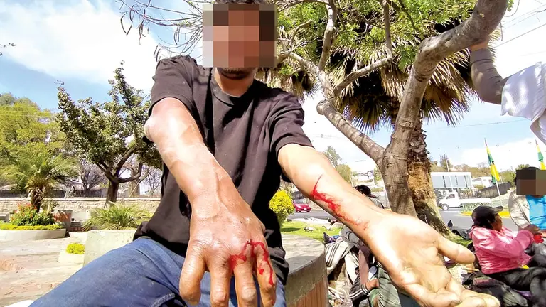 Uno de los afectados muestra las heridas de su brazo./ DICO SOL&Iacute;S