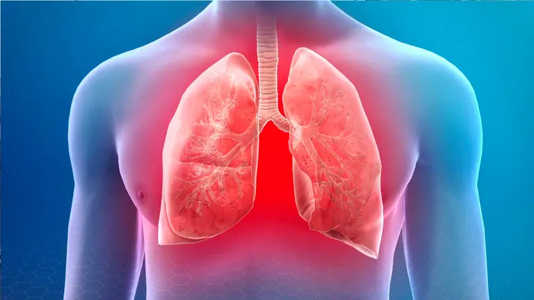 Foto referencial de los pulmones y la neumon&iacute;a./ PIXABAY