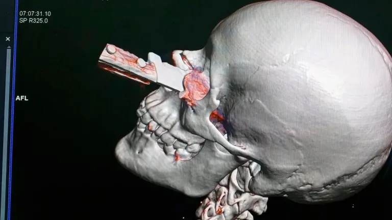 Imagen de la radiograf&iacute;a realizada a la joven. Cortes&iacute;a