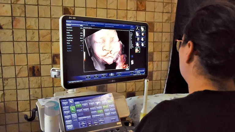 Imagen de un feto con una malformación, labio leporino./  DICO SOLÍS