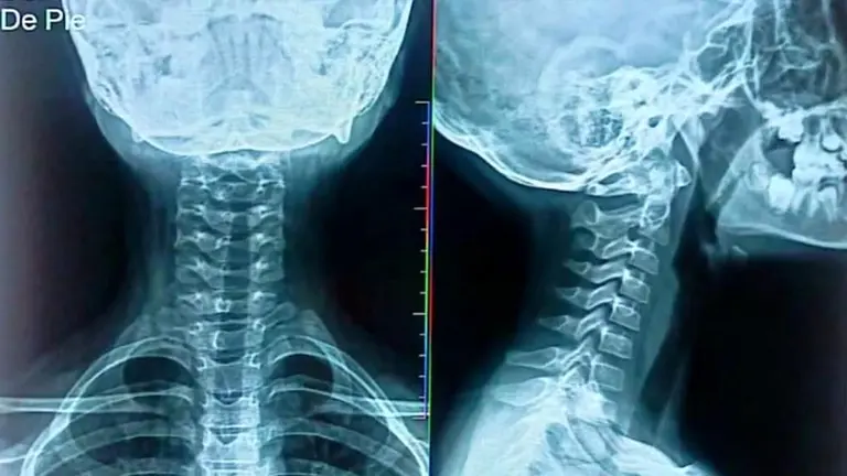 Radiograf&iacute;a de la ni&ntilde;a que sufri&oacute; un esguince cervical, consecuencia de un acto de violencia por parte de su profesor./CORTES&Iacute;A
